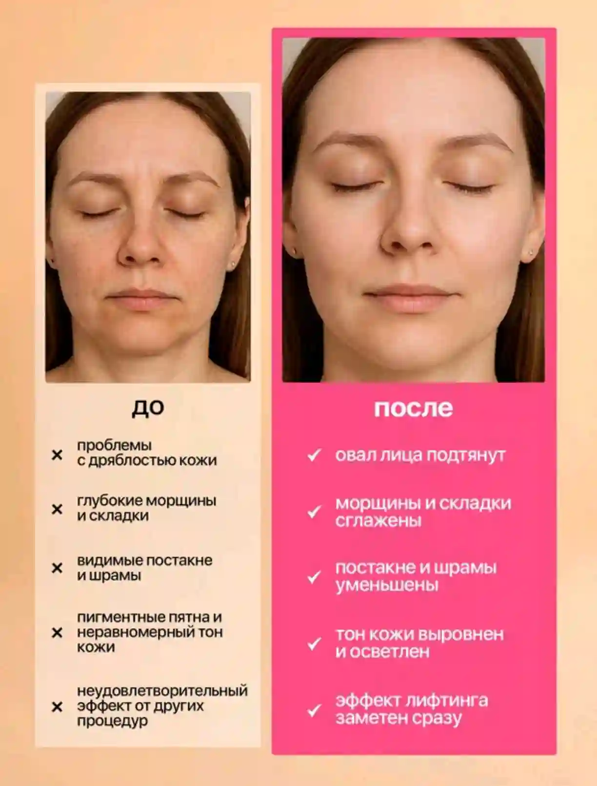 Ladiesparadise RF-лифтинг Аппарат РФ Лифтинг А2
